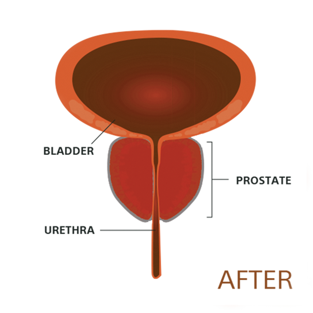 After Procedure