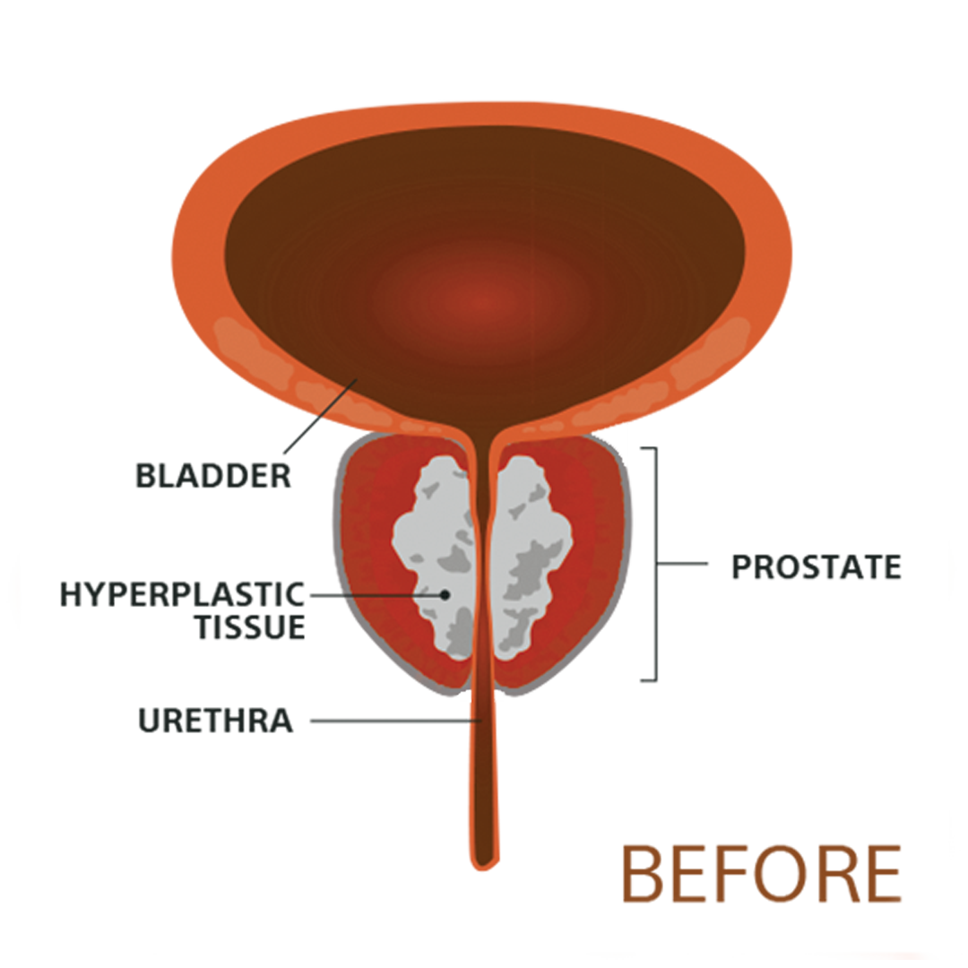 Before Procedure
